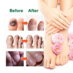 OUHOE Nail Fungal Treatment Serum