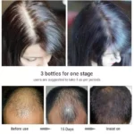 Ouhoe Hair Regrowth Treatment Spray