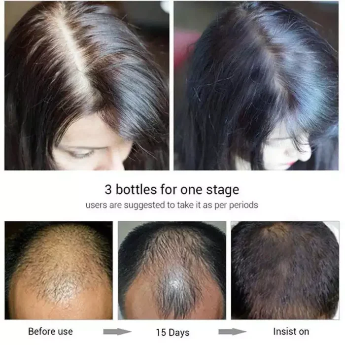 Ouhoe Hair Regrowth Treatment Spray